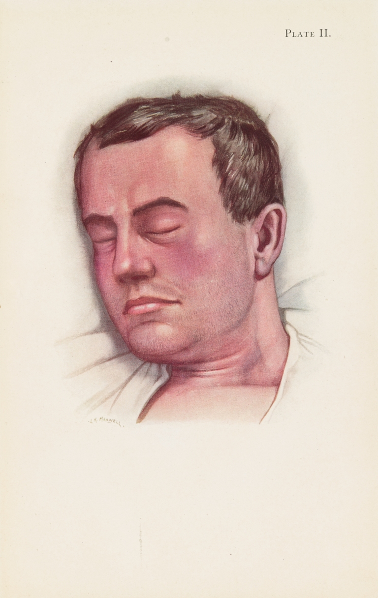 Plate II. Blue type of asphyxia from phosgene poisoning, with intense venous congestion by A. Kirkpatrick Maxwell