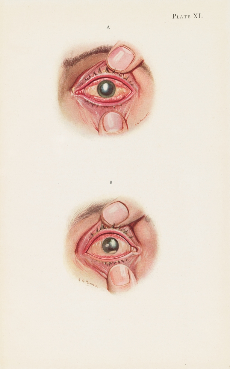 Plate XI. A. Severely burned eye in the acute stage. B. Slightly later stage of acute burning by A. Kirkpatrick Maxwell